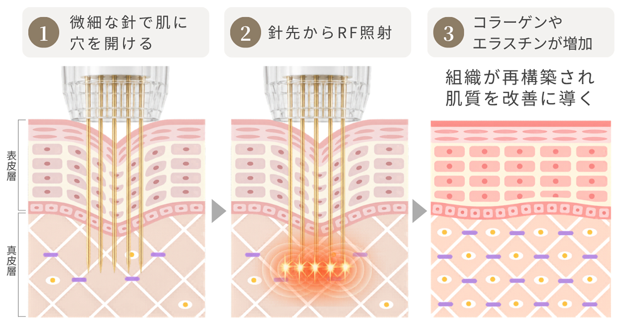 サーマニードルEVOの3つの肌育作用メカニズムの図解